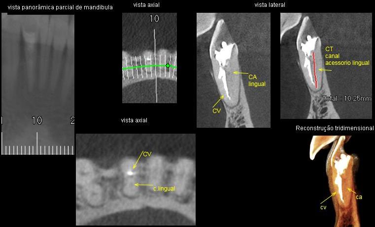 Endodontia em Águas de Lindóia – SP