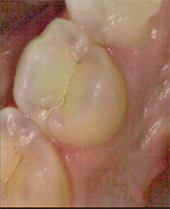 iTero Scanner Intra Oral em Pinhalzinho – SP