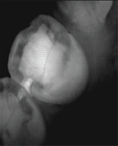 iTero Scanner Intra Oral em Itatiba – SP
